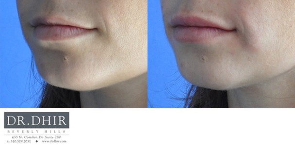 drdhir-lips-17-6