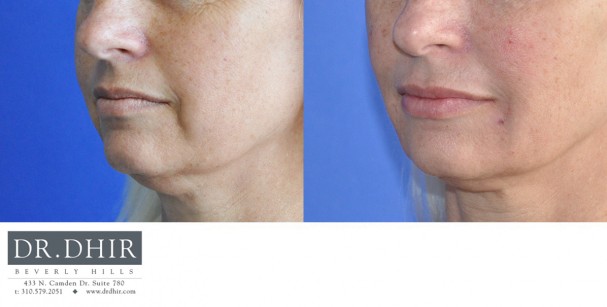 drdhir-lips-18-4