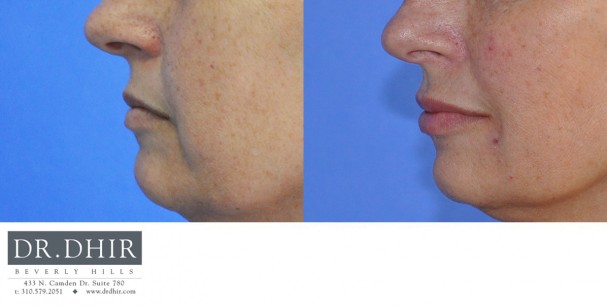 drdhir-lips-18-5