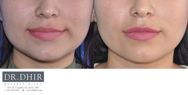 drdhir-lips-20-1