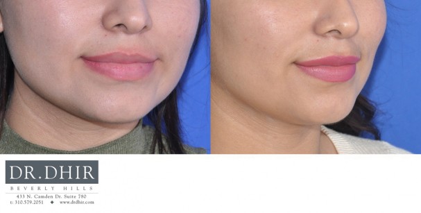 drdhir-lips-20-2