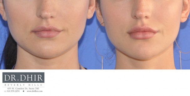 drdhir-lips-21-1