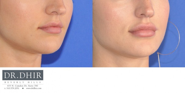 drdhir-lips-21-2