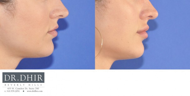 drdhir-lips-21-3