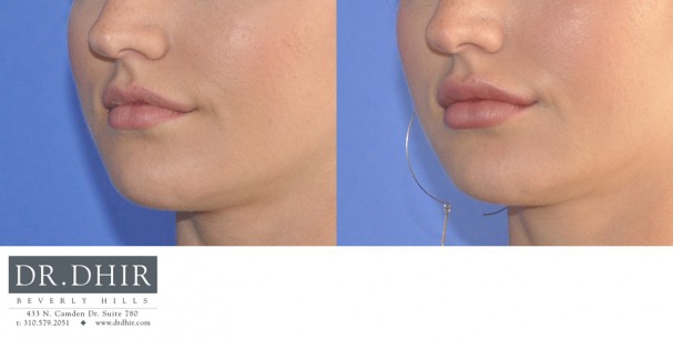drdhir-lips-21-4