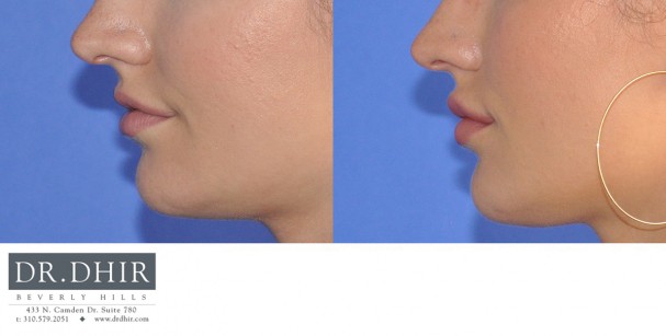 drdhir-lips-21-5