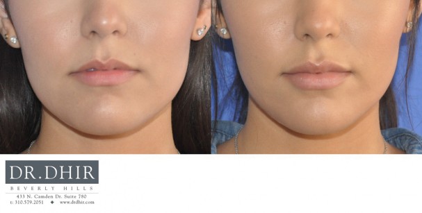 drdhir-lips-22-1