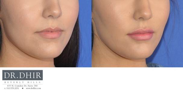 drdhir-lips-22-2