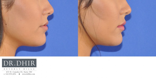 drdhir-lips-22-3