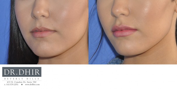 drdhir-lips-22-4