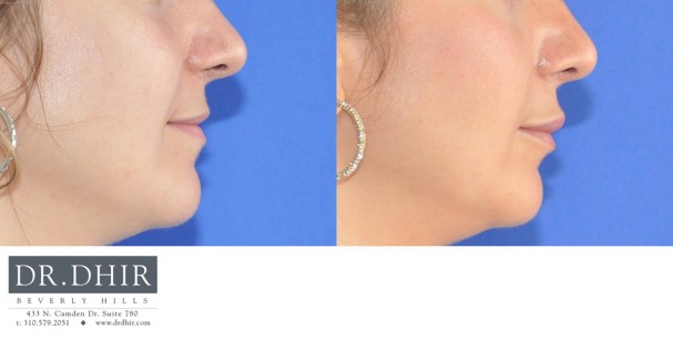 drdhir-lips-23-1