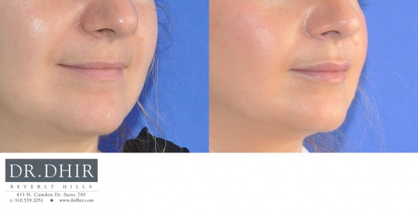 drdhir-lips-23-2