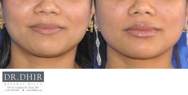 drdhir-lips-24-1