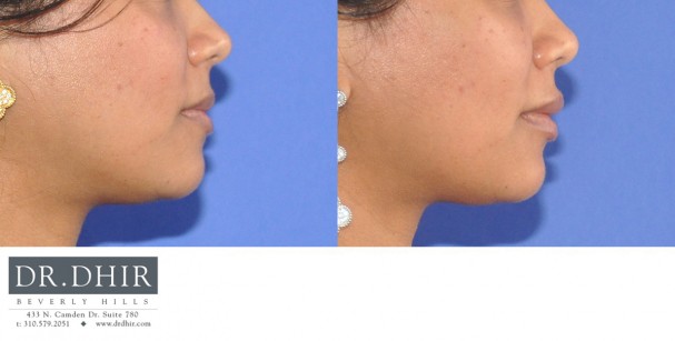 drdhir-lips-24-2