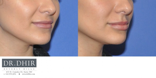 drdhir-lips-26-1