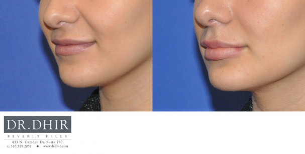 drdhir-lips-26-2