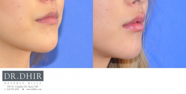 drdhir-lips-27-1