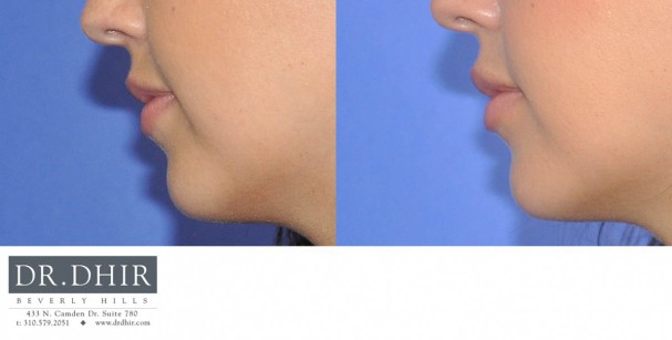 drdhir-lips-27-2