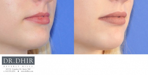 drdhir-lips-28-1