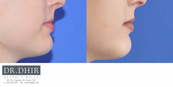 drdhir-lips-28-2