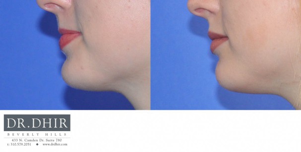 drdhir-lips-28-3