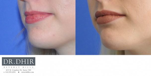 drdhir-lips-28-4
