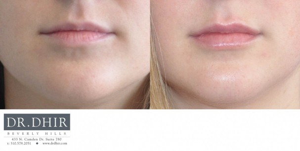 drdhir-lips-29-1