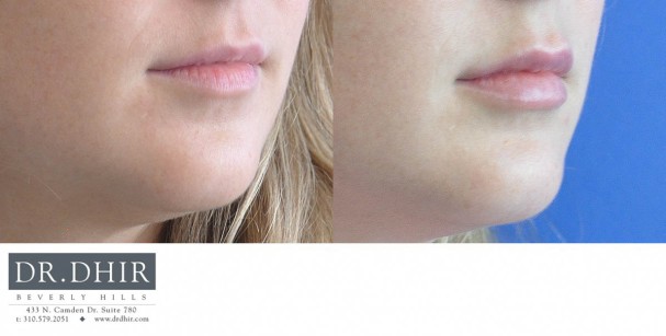 drdhir-lips-29-2