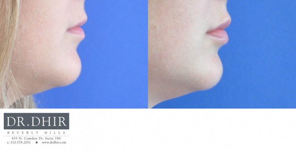 drdhir-lips-29-3