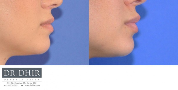 drdhir-lips-30-3