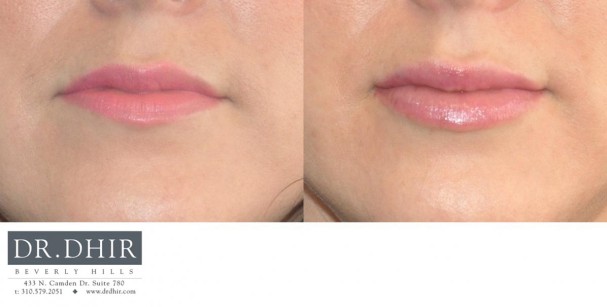 drdhir-lips-31-1