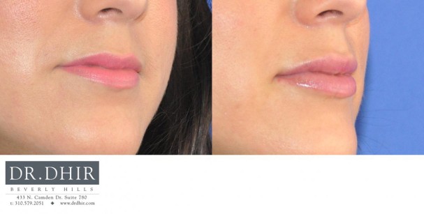 drdhir-lips-31-2