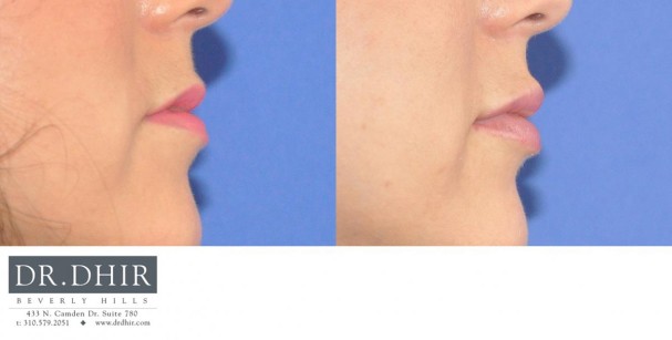drdhir-lips-31-3