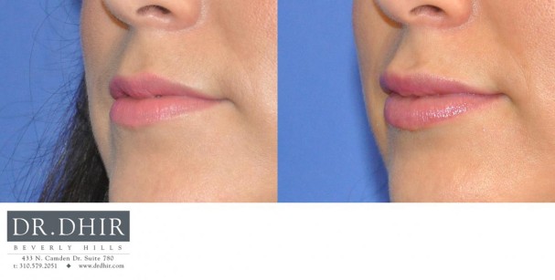 drdhir-lips-31-4