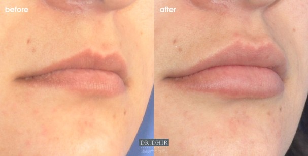 drdhir-lips-50-1