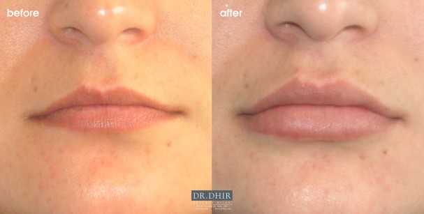 drdhir-lips-50-2