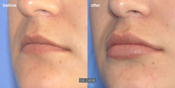 drdhir-lips-50-3