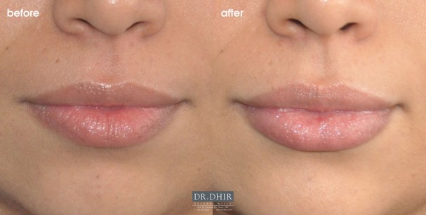drdhir-lips-51-1