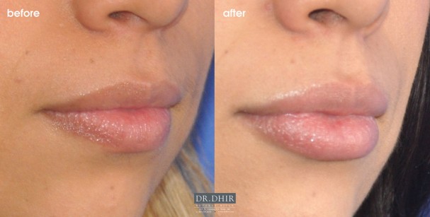 drdhir-lips-51-2