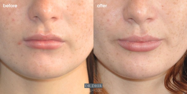 drdhir-lips-52-1
