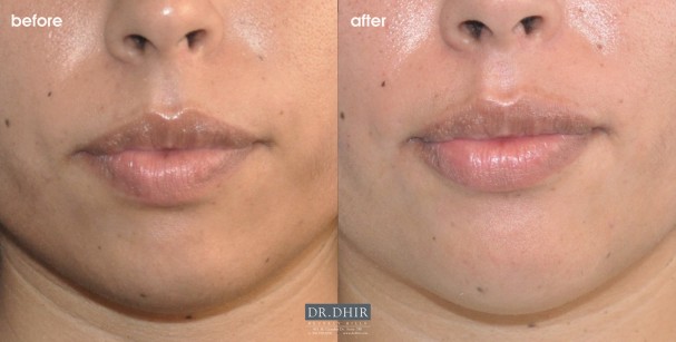 drdhir-lips-52-1
