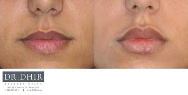 lips-6