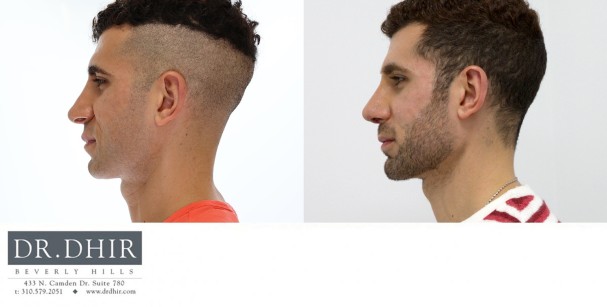 30 year old Male presented for revision rhinoplasty for nasal hump, poorly supported and over projected nasal tip that is was under rotated.  A revision rhinoplasty was performed with nasal hump removal, and rib graft cartilage grafting for tip refinement, deprojection and rotation.