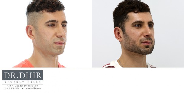 30 year old Male presented for revision rhinoplasty for nasal hump, poorly supported and over projected nasal tip that is was under rotated.  A revision rhinoplasty was performed with nasal hump removal, and rib graft cartilage grafting for tip refinement, deprojection and rotation.