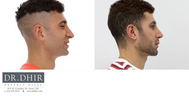 30 year old Male presented for revision rhinoplasty for nasal hump, poorly supported and over projected nasal tip that is was under rotated.  A revision rhinoplasty was performed with nasal hump removal, and rib graft cartilage grafting for tip refinement, deprojection and rotation.