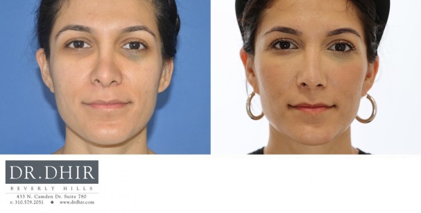 32 year old Middle Eastern Female presents for revision rhinoplasty for bulbous tip and excessive columellar hang.  A revision rhinoplasty was performed with rib graft cartilage to support and refine the nasal tip.