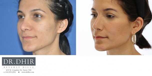 32 year old Middle Eastern Female presents for revision rhinoplasty for bulbous tip and excessive columellar hang.  A revision rhinoplasty was performed with rib graft cartilage to support and refine the nasal tip.