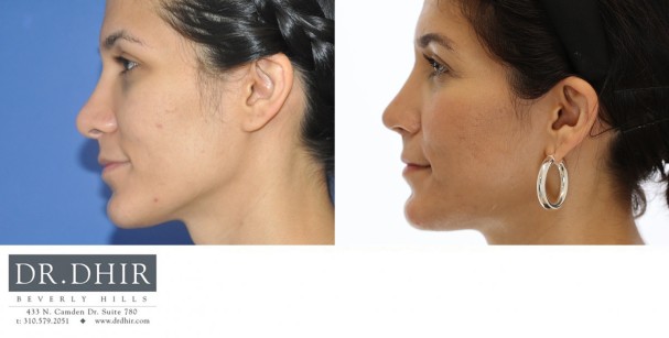 32 year old Middle Eastern Female presents for revision rhinoplasty for bulbous tip and excessive columellar hang.  A revision rhinoplasty was performed with rib graft cartilage to support and refine the nasal tip.