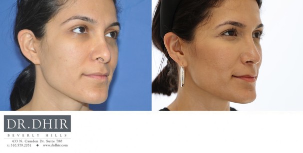 32 year old Middle Eastern Female presents for revision rhinoplasty for bulbous tip and excessive columellar hang.  A revision rhinoplasty was performed with rib graft cartilage to support and refine the nasal tip.
