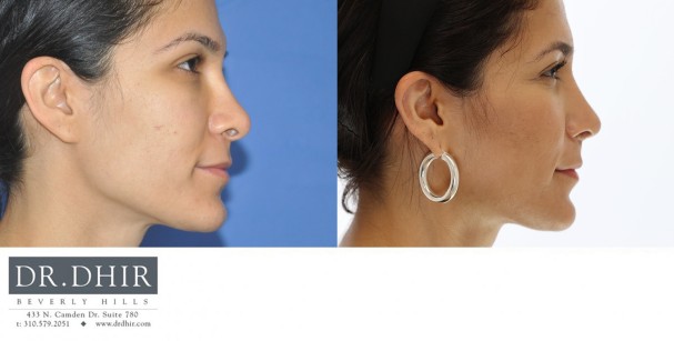32 year old Middle Eastern Female presents for revision rhinoplasty for bulbous tip and excessive columellar hang.  A revision rhinoplasty was performed with rib graft cartilage to support and refine the nasal tip.
